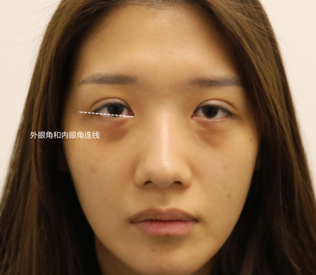 她的眼睛本身并不存在眼角下垂的问题,她的问题在于本身上眼睑组织