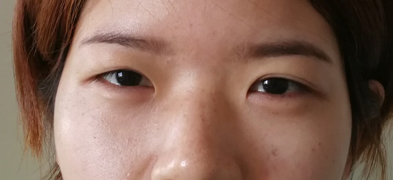 术前的样子:三角眼,眼睛大小不对称,内眦赘皮这位姑娘就是很好的例子