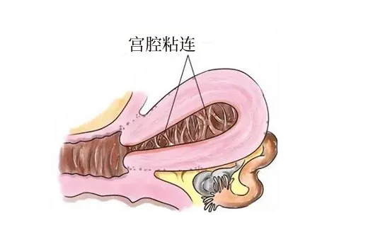 不孕可能是宫腔粘连在捣鬼