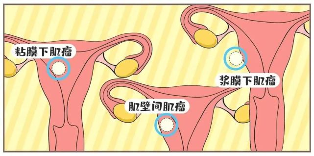 肌瘤生長大部分突出於子宮漿膜面.