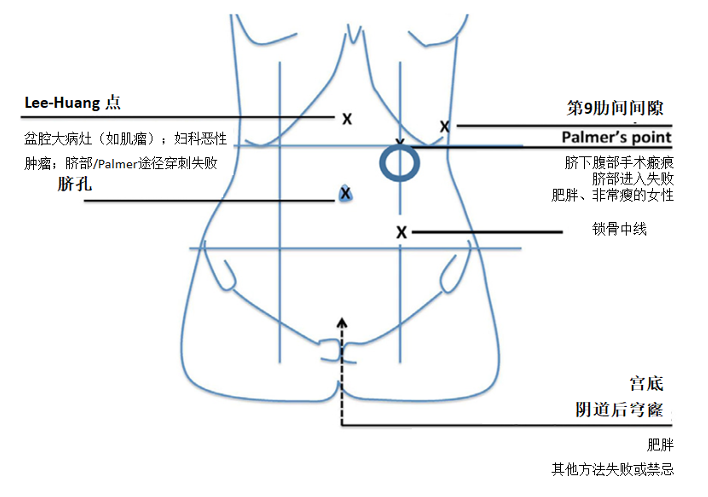 sogc|妇科腹腔镜手术的进腹指南(no.412)解读