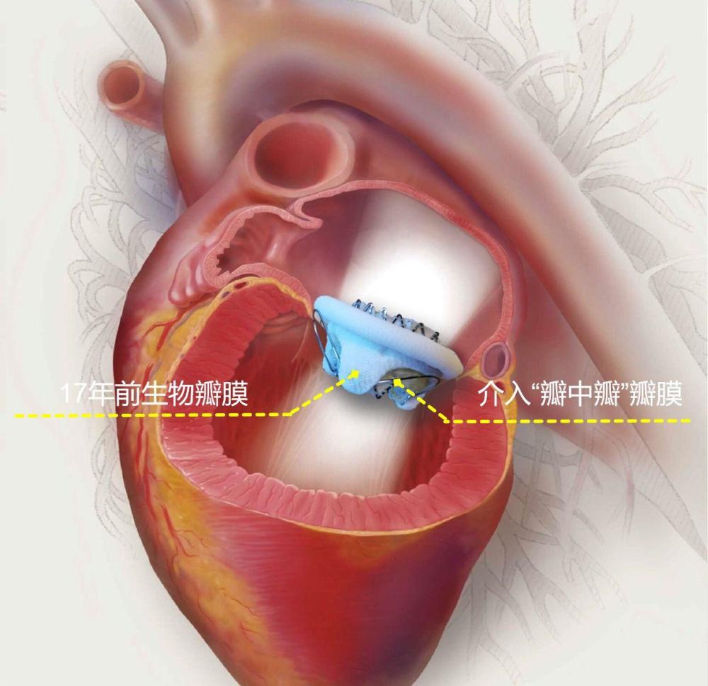 医生为她实施了"主动脉瓣 二尖瓣置换术",一次置换了两个心脏瓣膜