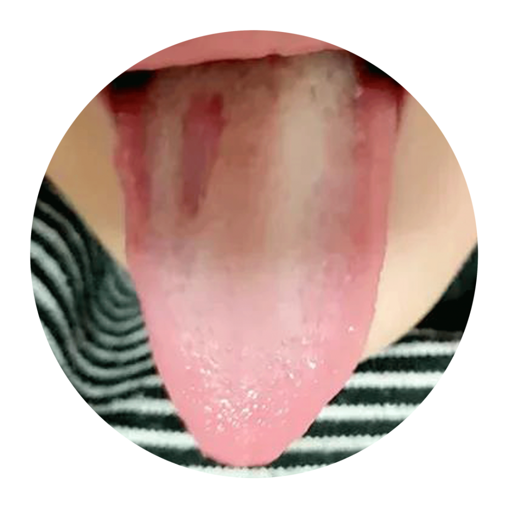 孩子的舌苔属于 地图舌 吗 腾讯新闻