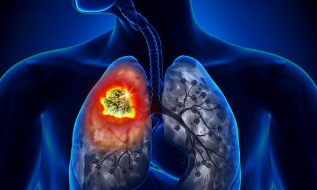 肺癌从早期—晚期需要多长时间?怎样才能及时发现?医生告诉你