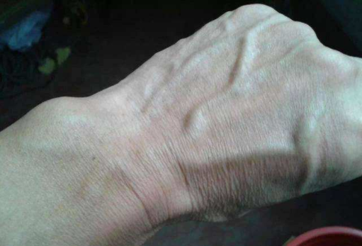 而是指的皮肤下面可见的较为粗壮的静脉和毛细血管,有的时候我们也