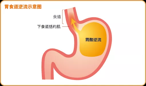 出現燒心的症狀別輕忽胃食道逆流