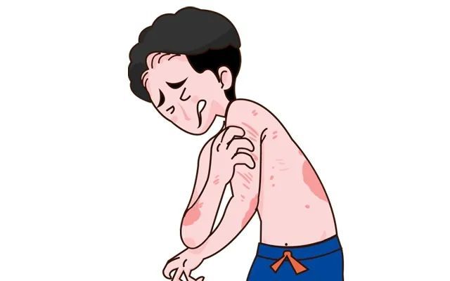 5%之间,伴瘙痒的银屑病患者中,57%~90%伴中重度瘙痒,45%~77%的患者