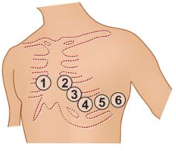 顛覆傳統,巧看心電圖:v1,v2,v3導聯不僅僅是胸前導聯