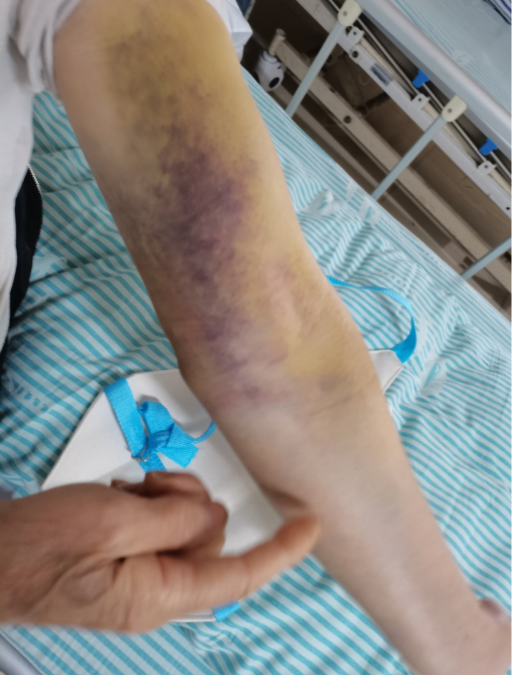 天上掉下一只乌龟长沙68岁老人被砸伤肇事者至今未现身