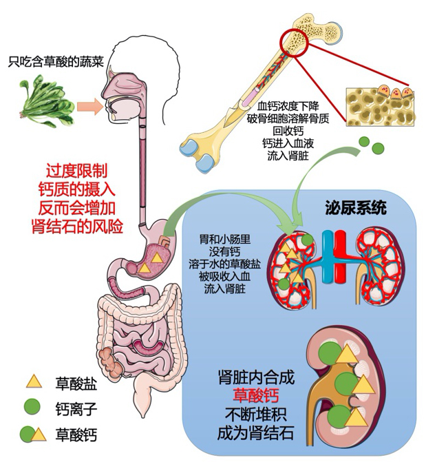 草酸钙结石怎么溶解图片