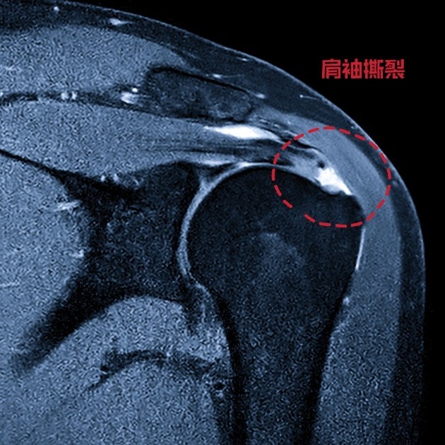 得了肩周炎拼命甩肩膀就行医生说有更好办法没必要冒险损伤肩袖