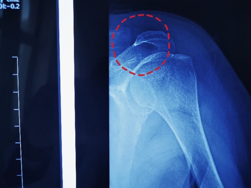 得了肩周炎拼命甩肩膀就行医生说有更好办法没必要冒险损伤肩袖