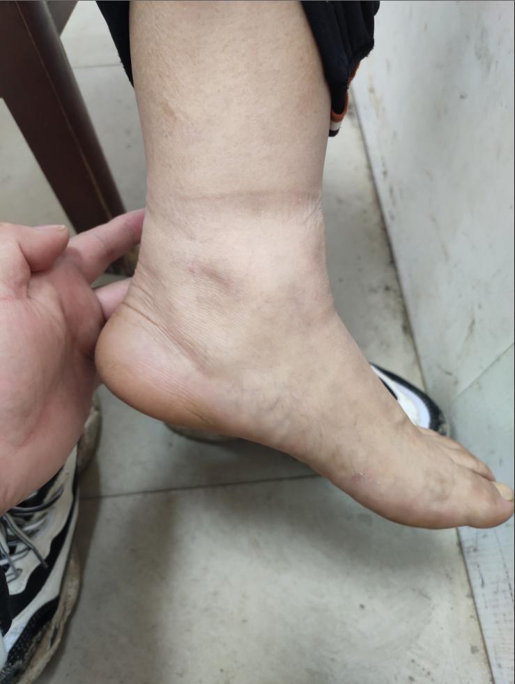 咳喘水肿肺心病心力衰竭伤寒经方苦药汤效果卓越