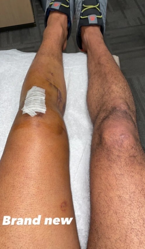 掘金球星贾马尔-穆雷今日在其个人社媒晒出了一张左膝手术后的照片