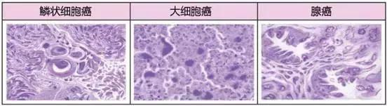 肺癌分型有四种 哪一种最难治 这里有答案 腾讯新闻