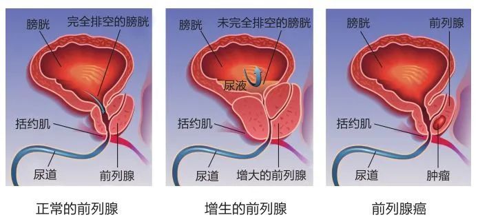 迷一樣的前列腺鈣化看完你就明白