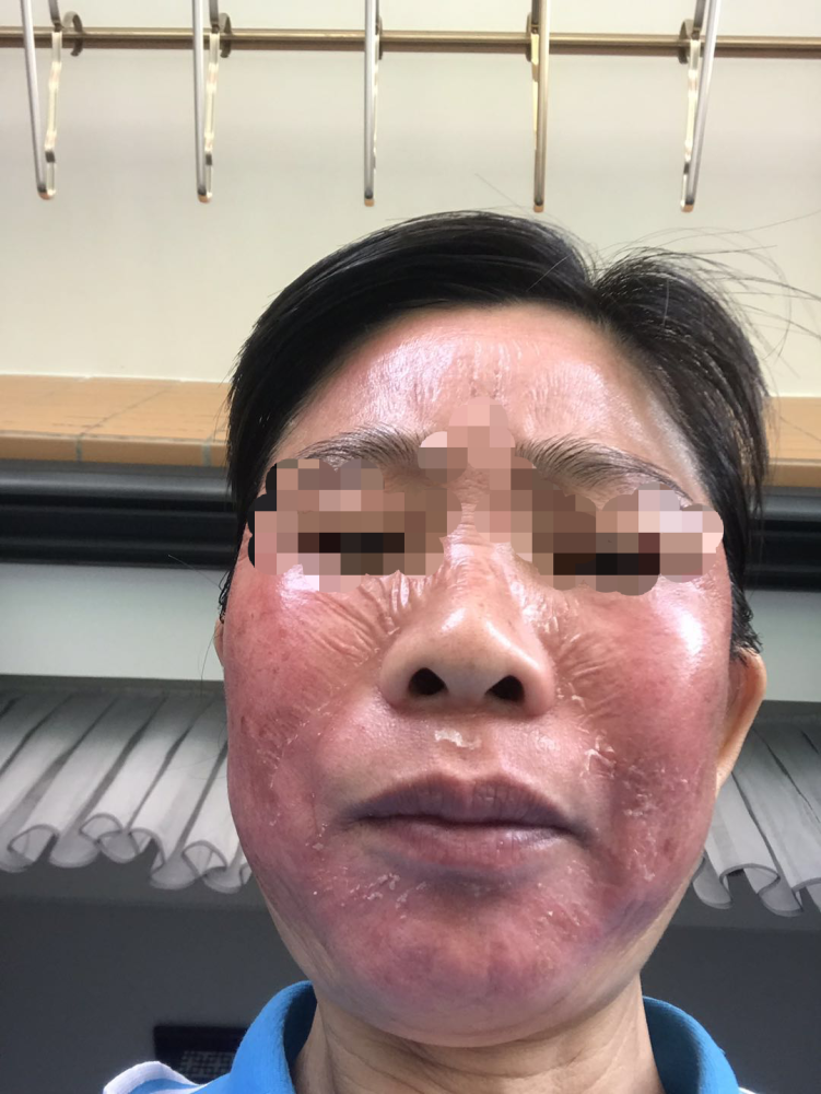专 帮|女子花3800做激光祛斑惨遭毁容,美容院涉医美要当心!_腾讯新闻