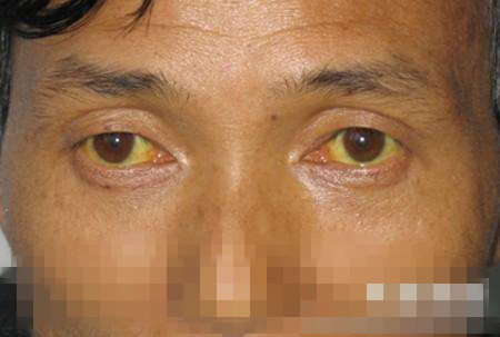 颈部|黄疸|肝脏|喝酒|巩膜|病毒性肝炎|肝掌|血管|症状|肝硬化
