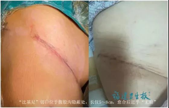 的是,切口巧妙隐藏在腹股沟的隐蔽处,愈合后穿着泳衣也看不到创口疤痕