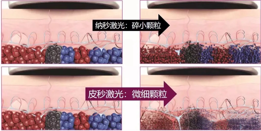 对于黑色素的捕捉也更加精准及快速,穿透也更透,所以一些纳秒级激光