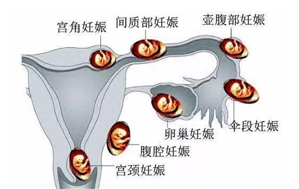 绚丽的什么是宫外孕的视图
