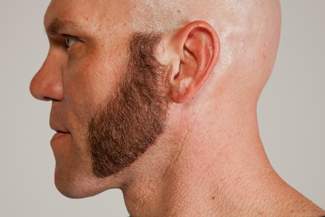 植鬓角效果怎么样