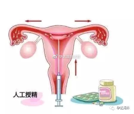 不孕促排卵过程中最关注的5个问题