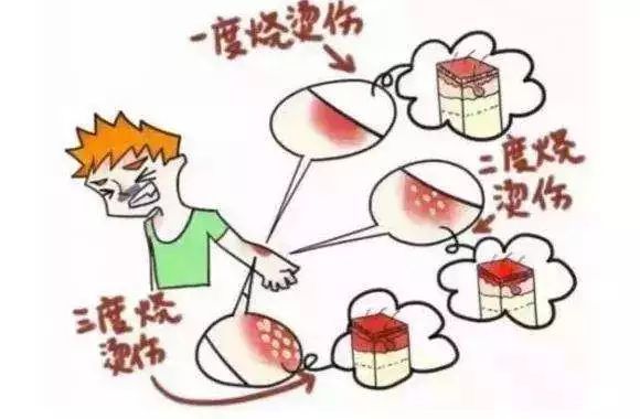 这些烧烫伤知识请储存!