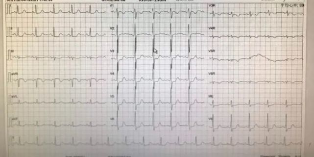 典型"6 2"心电图,造影却正常,这个病例忽视了什么?-腾讯新闻