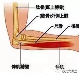 通常是指肘关节外侧肱骨外上髁的位置发生疼痛