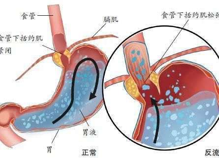 吞咽或者进食的时候,食管下括约肌开启,食物达到胃里时,食管下括约肌