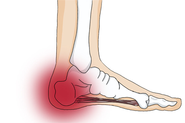 治疗足后跟痛的偏方_民间脚后跟痛偏方治疗_脚后跟痛警惕三种病怎么治