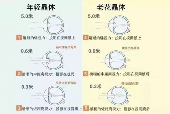 美丽岛多焦镜:近视眼,为啥老了还要配老花镜?