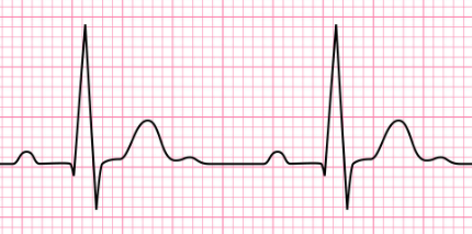 一次跳动所产生的电活动变化图形的技术,真实反映心肌细胞的兴奋起源