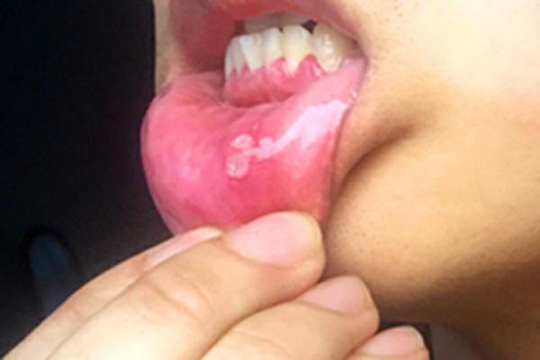 喜欢嚼槟榔的人,一旦出现4个异常情况,或说明口腔癌即将临门