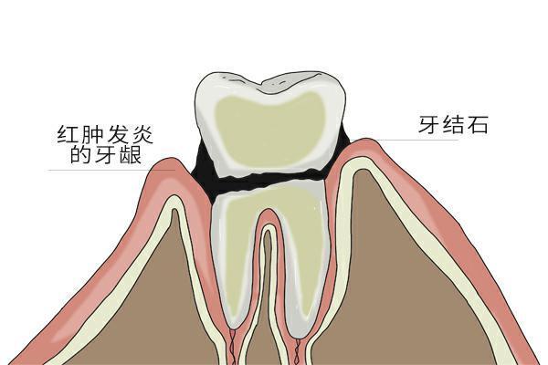 異常三:口腔黏膜顏色發白正常人張開嘴巴的時候,嘴巴內部的顏色都是