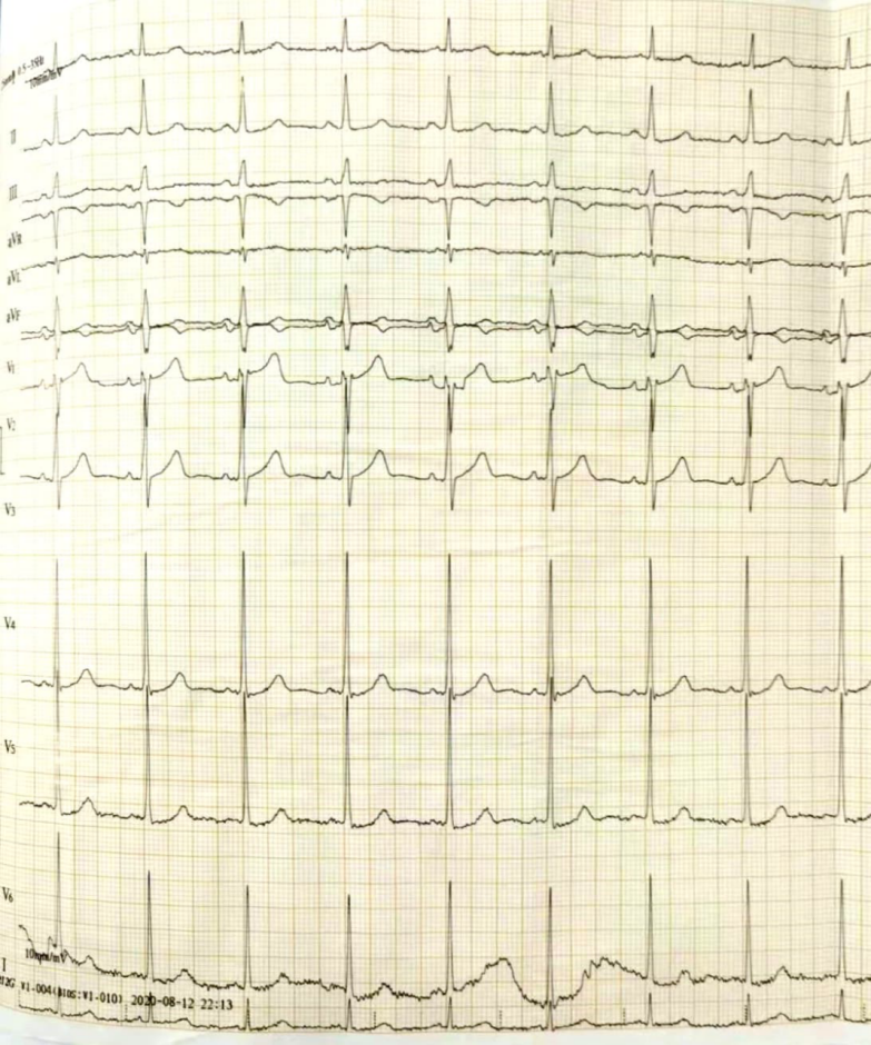 精彩病例丨cdqi名家面对面第三十二期 冠心病合并房颤患者综合治疗一例 腾讯新闻