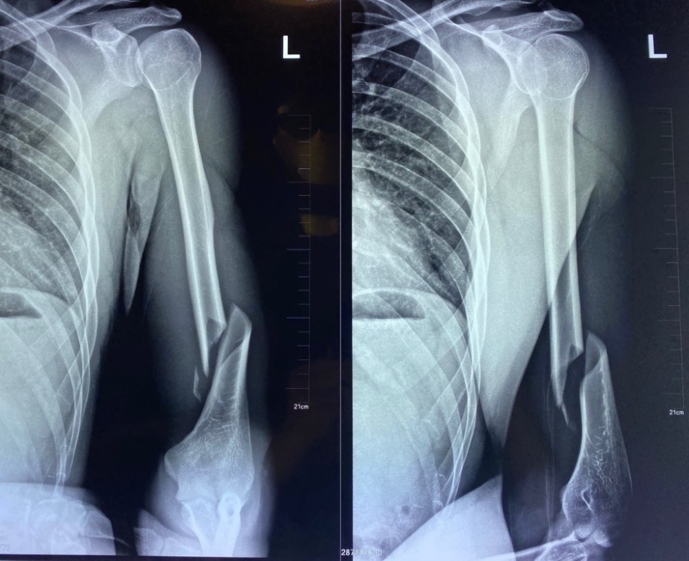 大力出悲剧28岁小伙子掰手腕掰断了胳膊