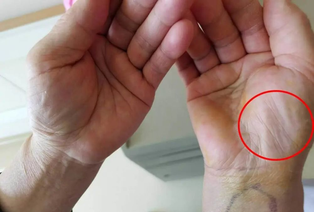 使手部的正中神经受损,而产生手指僵,麻木,酸痛无力的现象,最终被确诊