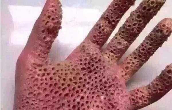 密集恐惧症(trypophobia)主要表现为对排列相对较小的密集物体(如成簇