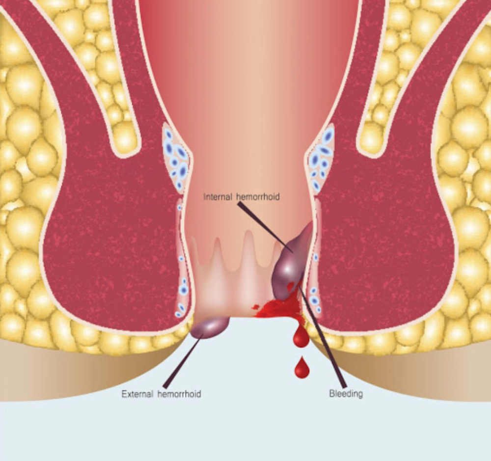 gut重磅近100万人研究首次揭示痔疮发病新机制