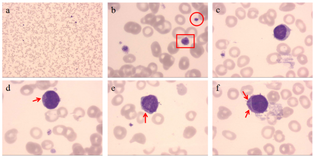 尽管由于患者白细胞总数下降,在显微镜下能计数到的细胞数很少,但最终