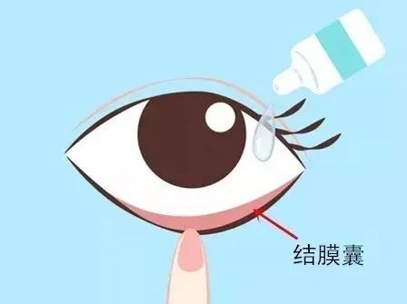 眼睛向上看,將1~2滴眼藥水滴入結膜囊中;5.