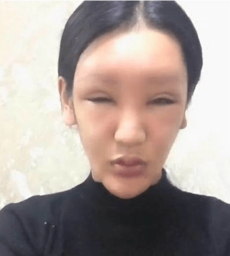知名网红脂肪填充失败,因审美畸形变成"蛇精脸"