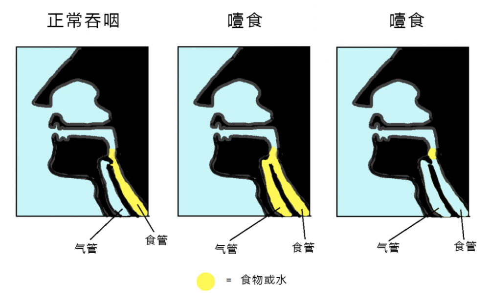 "老人噎食的正确处理方法"和"如何防止噎食