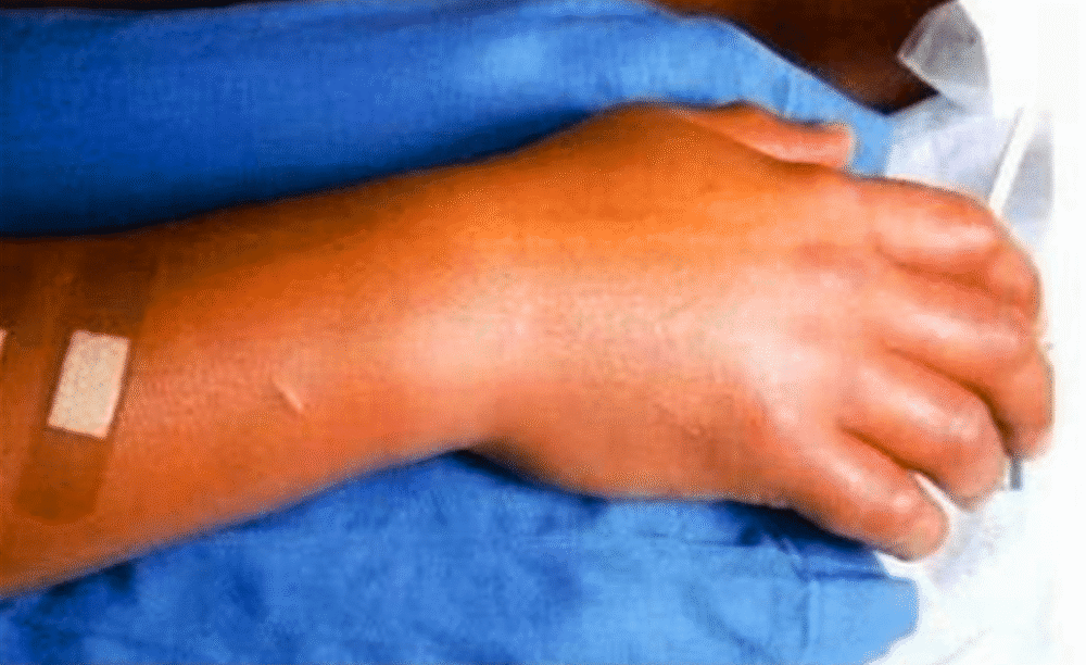 死法最惨烈日本人近距离遭受核辐射后医生强行令其存活83天