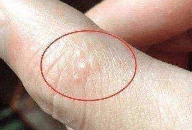 原因二:湿气过重所致除了是真菌感染的缘故之外,汗疱疹的发生还与人体