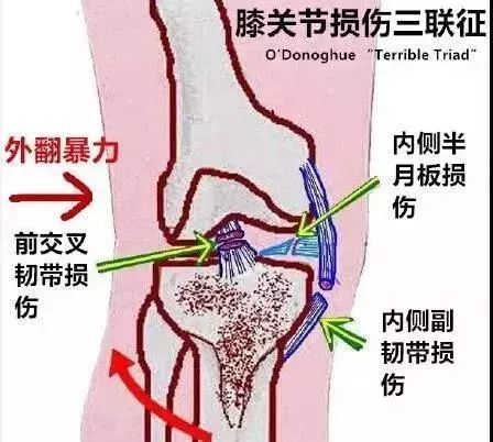 膝关节常见损伤特征总结 腾讯新闻