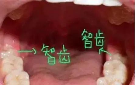 怎么知道自己有没有长智齿长了智齿要不要拔掉