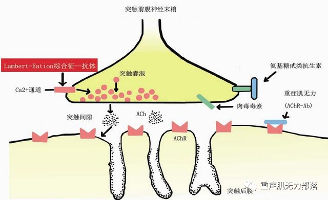 重症肌无力患者可以停服溴吡斯的明片吗